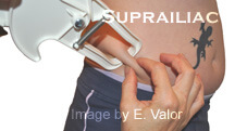 3-Site Body Composition Calculator: Female suprailiac caliper measurement